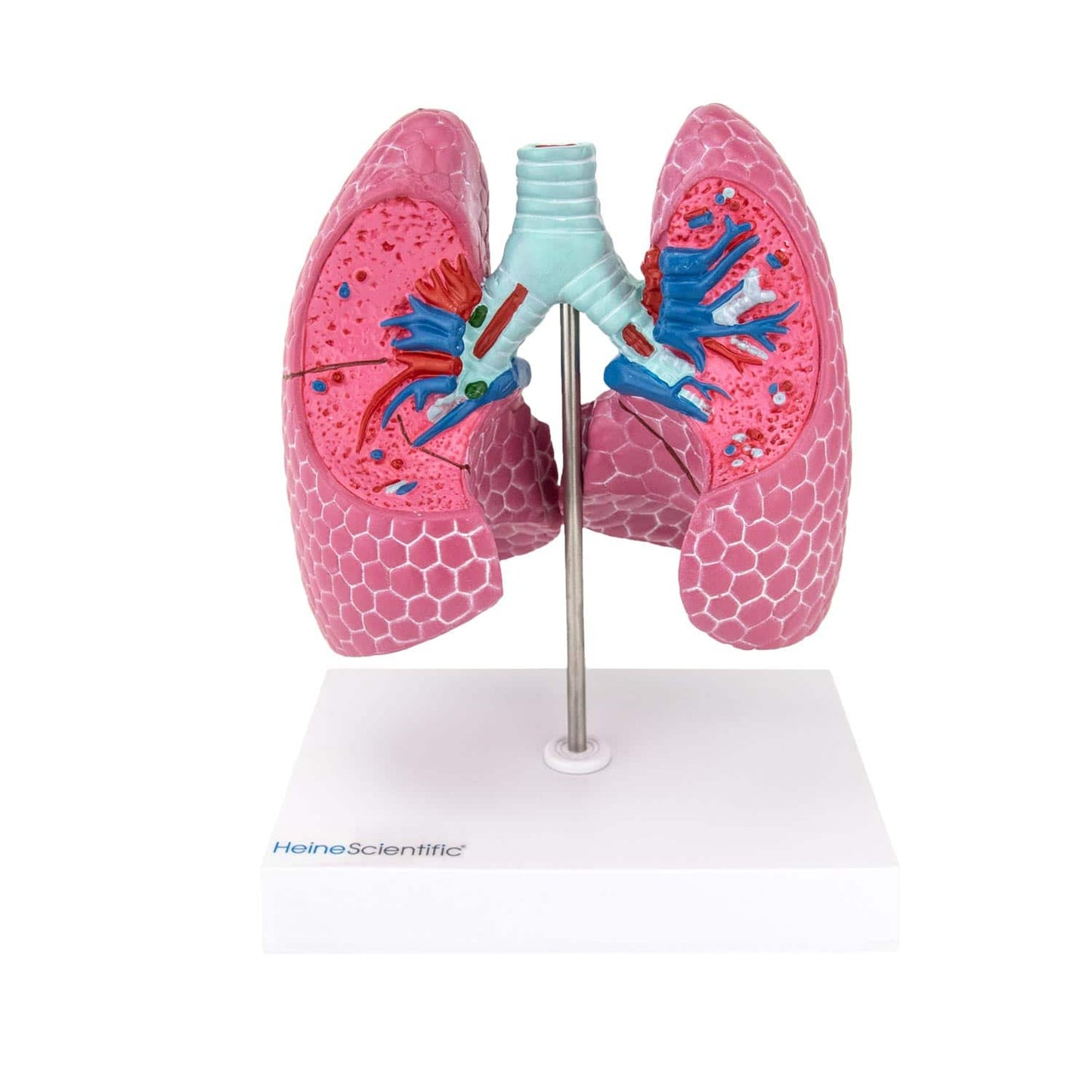 Lungen-Modell mit Erkrankungen Detailansicht - zeigt Tuberkulose, Pneumonie und Bronchiektasen - Med-Praxisbedarf