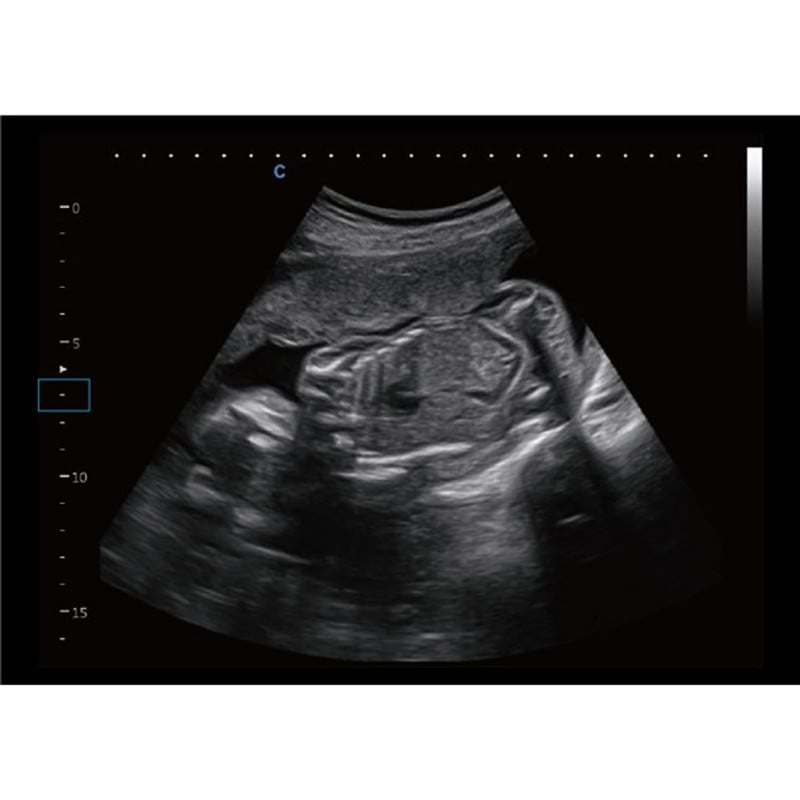 CBit9 Ultraschall von Chison - Gerät in klinischer Anwendung mit Darstellung der Farbdoppler-Funktion - Med-Praxisbedarf