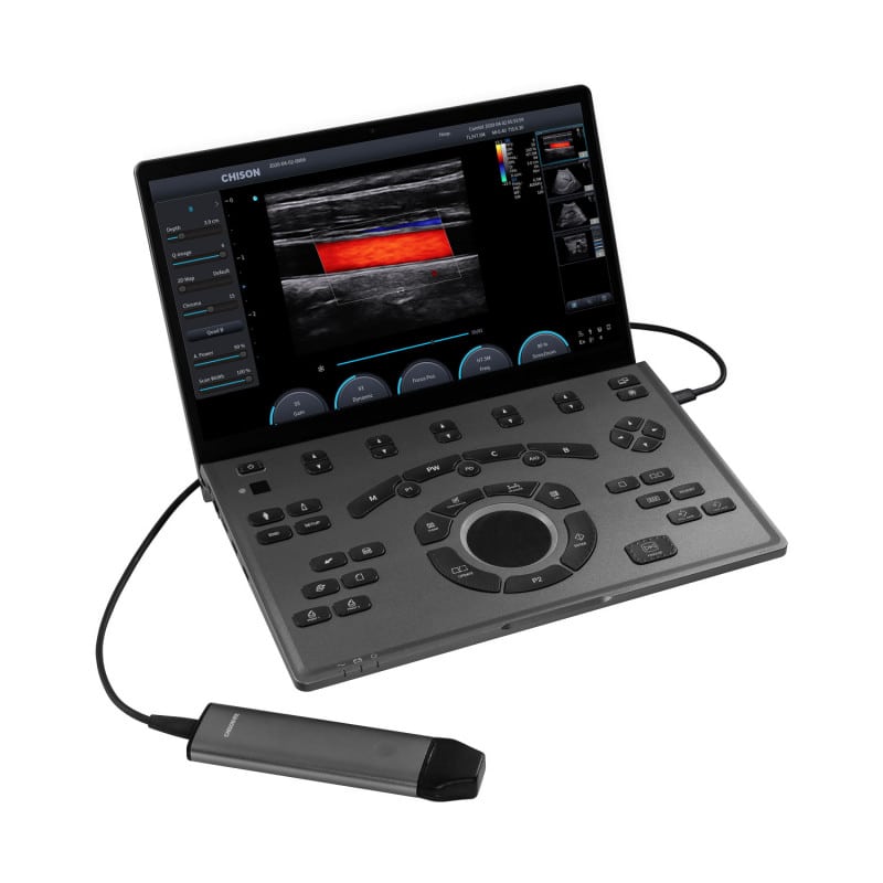 SonoAir 30 Ultraschallsystem von Chison - geöffnet, zeigt großen Bildschirm und Tastatur - Med-Praxisbedarf