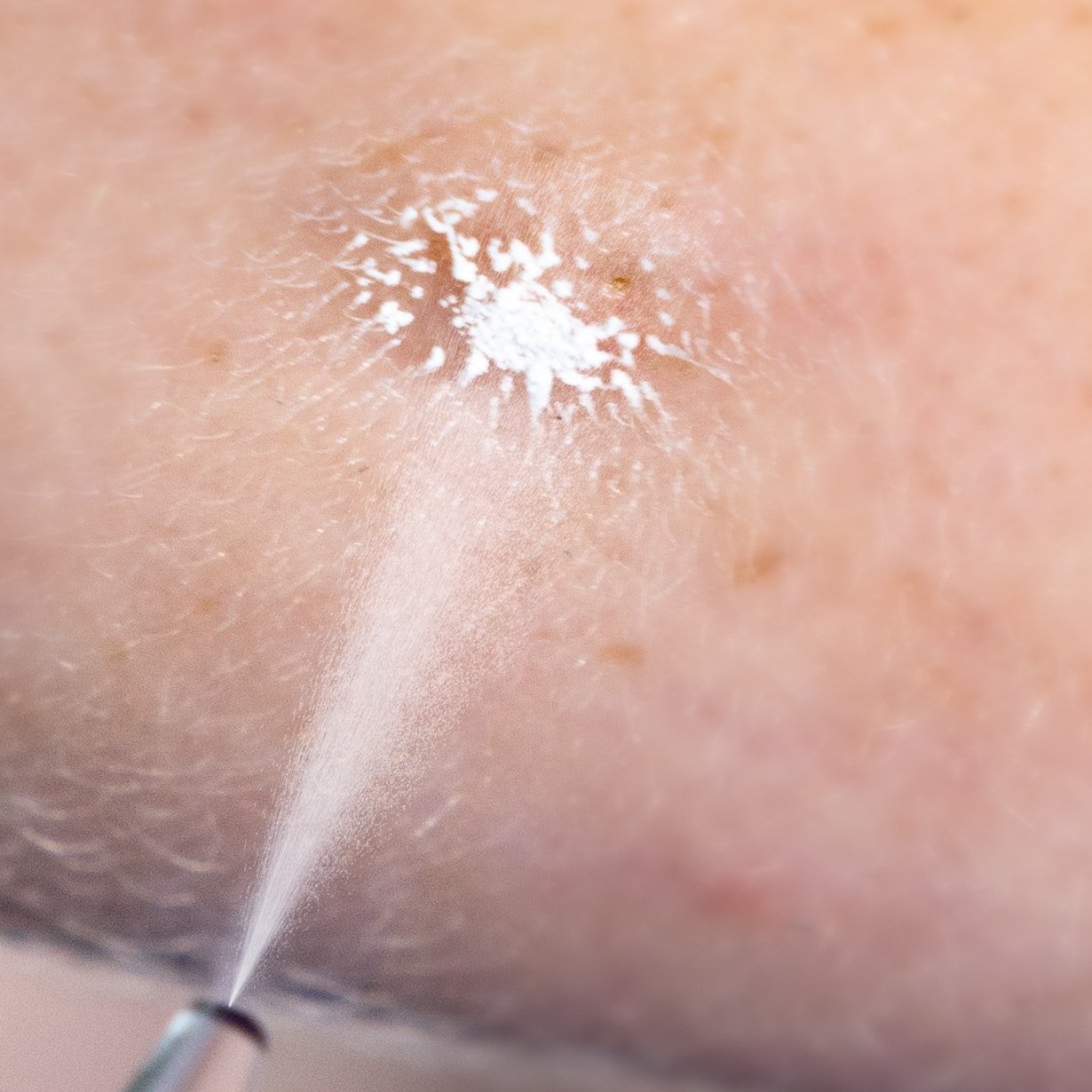 Cryoalfa LUX DermMix seitliche Ansicht - ergonomisches Design und technische Details - Med-Praxisbedarf