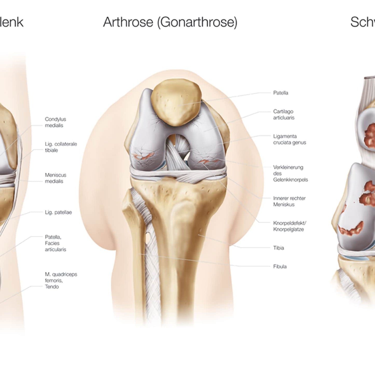 Anatomielehrtafel für Knie und Hüftgelenk - zur Patientenaufklärung in Pflegeeinrichtungen - Med-Praxisbedarf