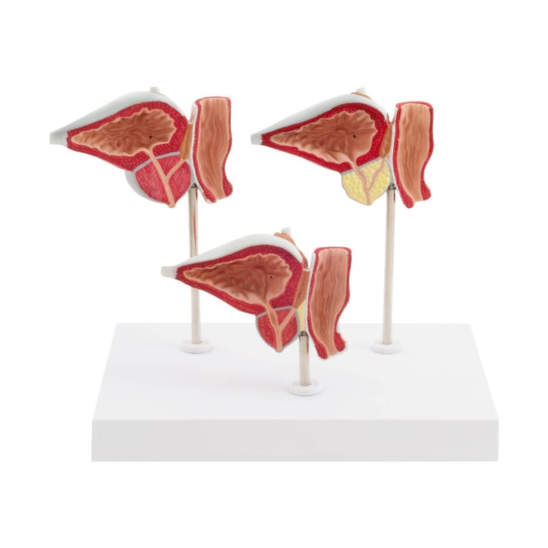 3-teiliges Prostata-Modell mit Erkrankungen - anatomisches Demonstrationsmodell von HeineScientific - Med-Praxisbedarf