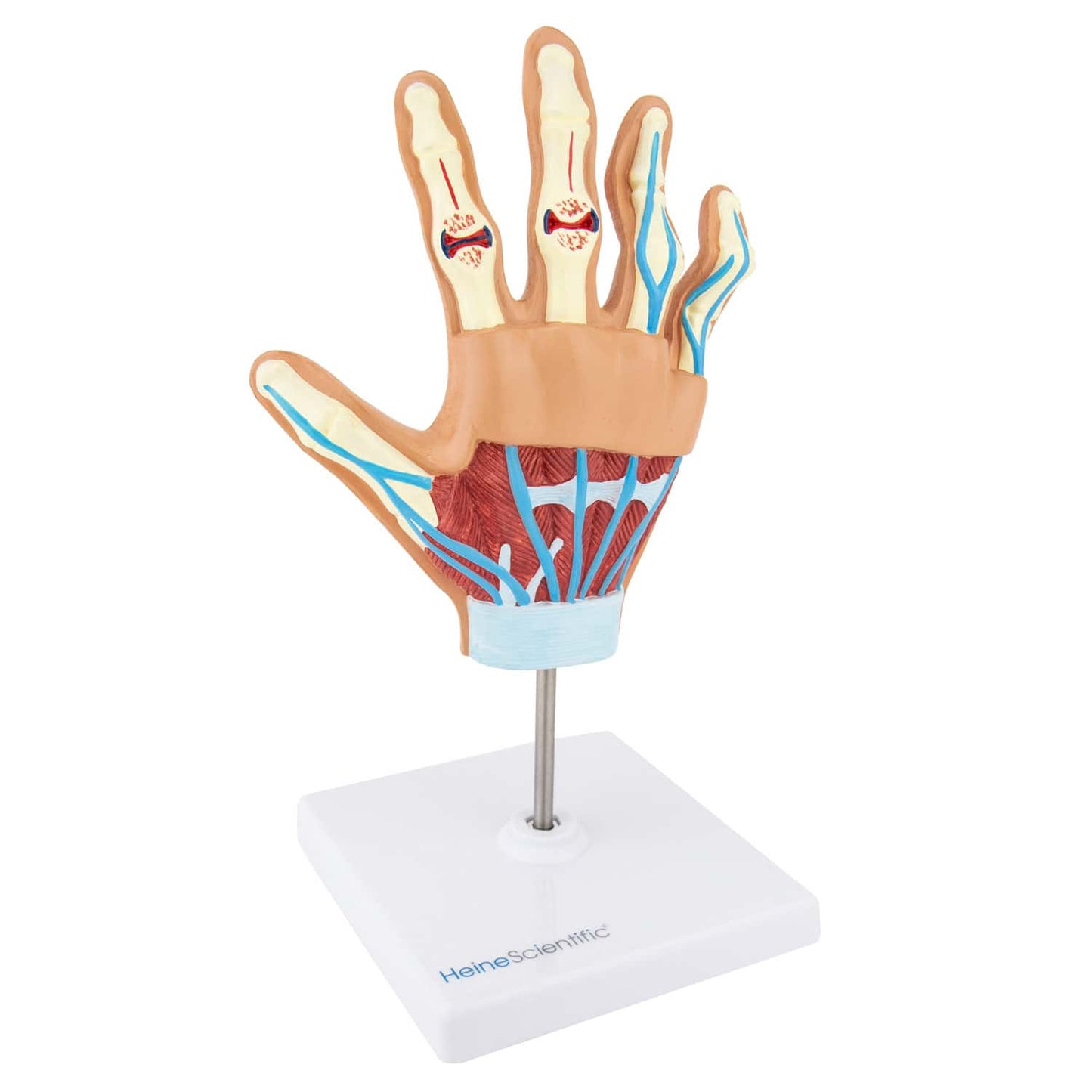 Anatomisches Handmodell rheumatoide Arthritis - zeigt Knochen- und Knorpelschäden im Detail - Med-Praxisbedarf