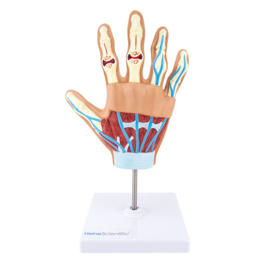 Handmodell mit rheumatoider Arthritis von HeineScientific - zeigt Gelenkveränderungen anschaulich - Med-Praxisbedarf
