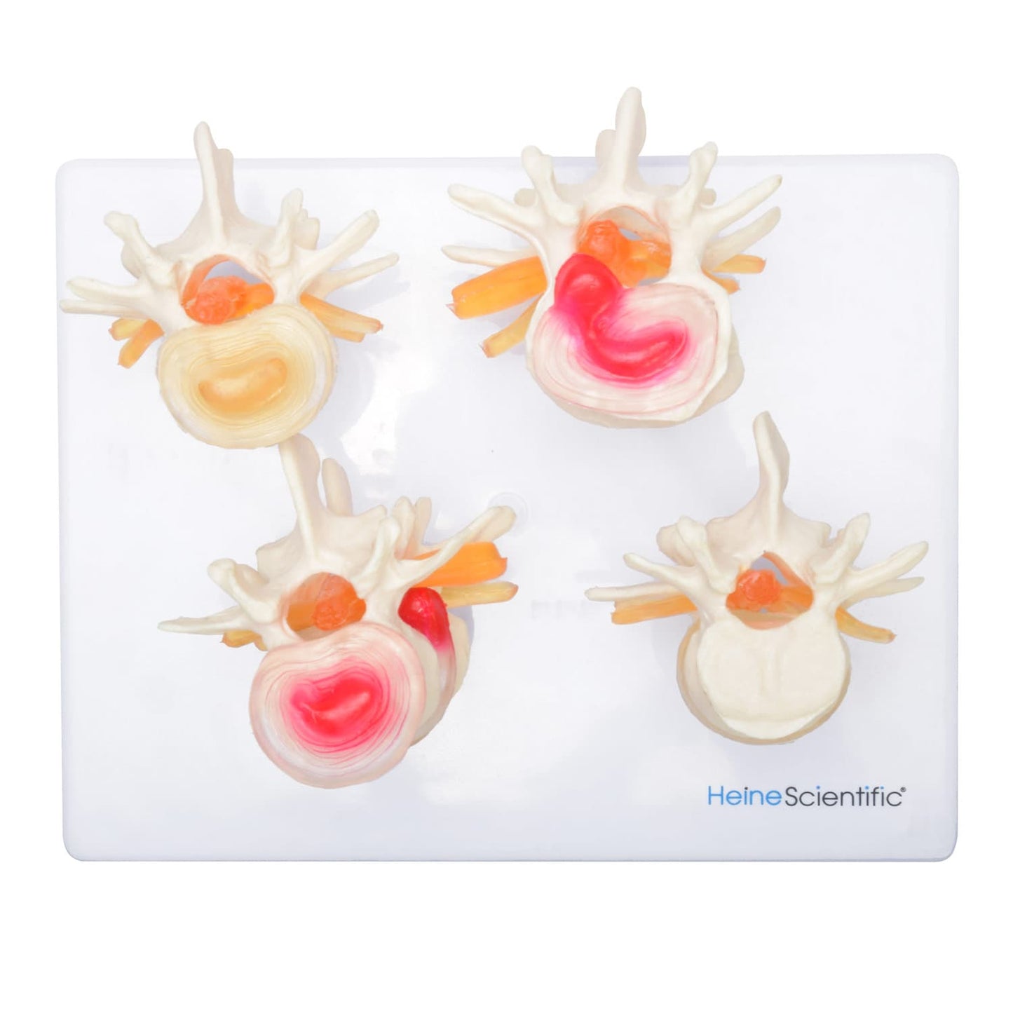 Anatomisches Bandscheibenmodell von HeineScientific - Demonstrationsmodell für Pathologie und gesunde Struktur - Med-Praxi...