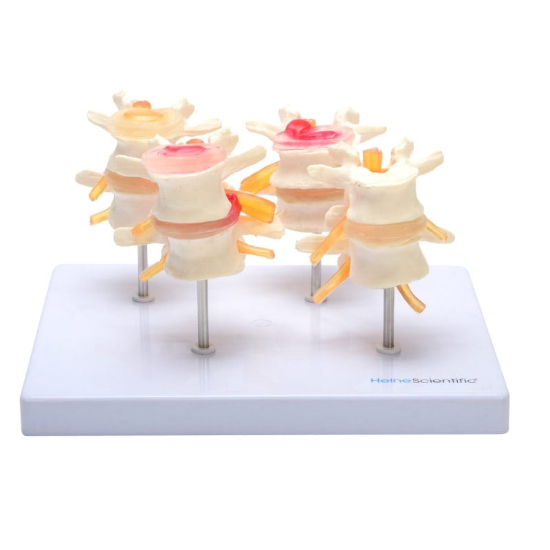 HeineScientific Bandscheibenmodell 4-teilig - anatomisches Modell für medizinische Ausbildung, gesunde Bandscheibe - Med-P...
