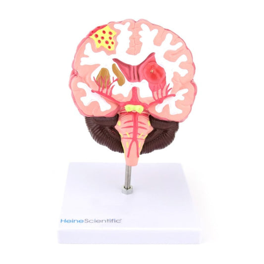 Gehirnmodell mit Erkrankungen im Längsschnitt - anatomische Anschauung, 18 cm hoch - Med-Praxisbedarf