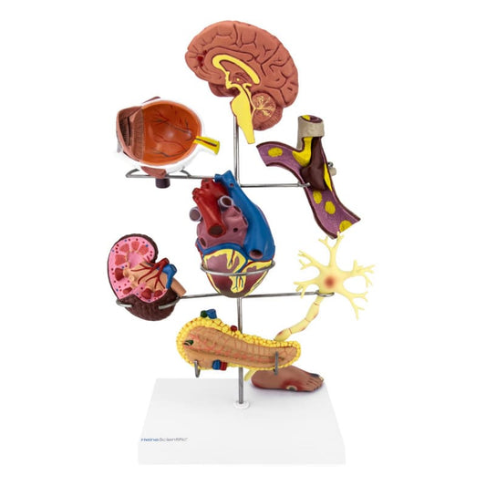 Diabetes Folgen Modell - gesundheitliche Probleme bei Diabetes mellitus anschaulich dargestellt - Med-Praxisbedarf