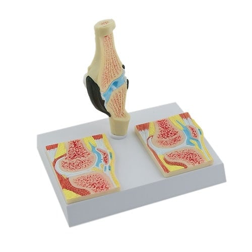 Kniegelenk mit Arthritis Längsschnitt - detailreiches anatomisches Reliefmodell für die Ausbildung - Med-Praxisbedarf