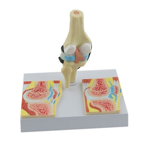 Anatomiemodell rheumatoide Arthritis Knie - HeineScientific Modell im Detail für Studium und Praxis - Med-Praxisbedarf
