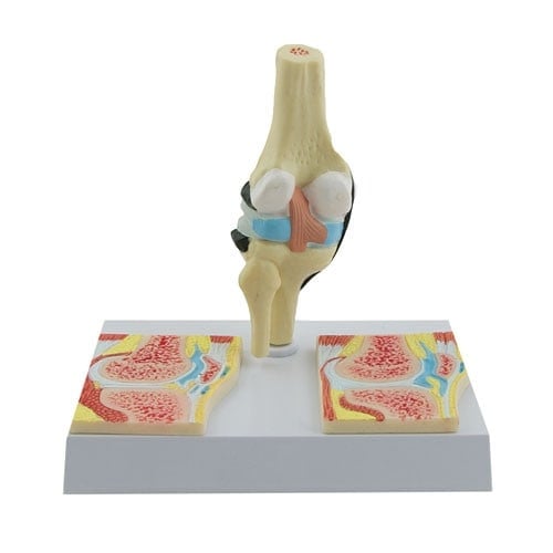 Rheumatisches Kniegelenk Modell - anatomisches Demonstrationsmodell mit rheumatoider Arthritis - Med-Praxisbedarf