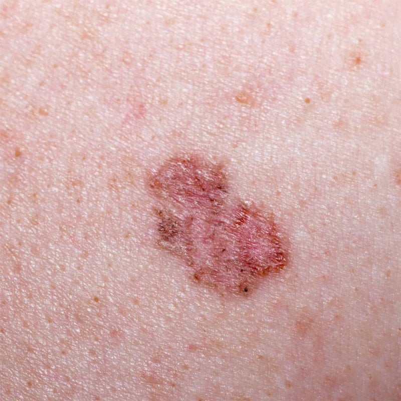 Dermatoskop LuxaScope CCT - kompaktes Gerät zur Untersuchung von Muttermalen und Hautveränderungen - Med-Praxisbedarf