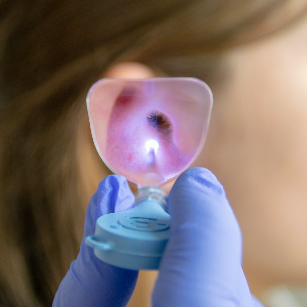 Ohr-Kürette Bionix Detailansicht - Vergrößerungslinse für optimale Sicht im Gehörgang - Med-Praxisbedarf